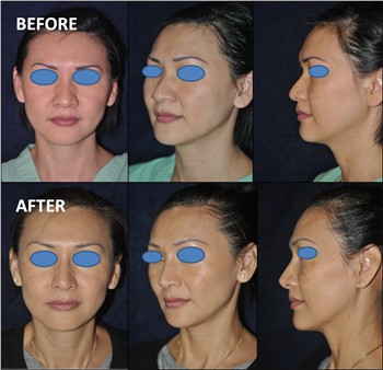 Rhinoplasty Thailand and dermatology center