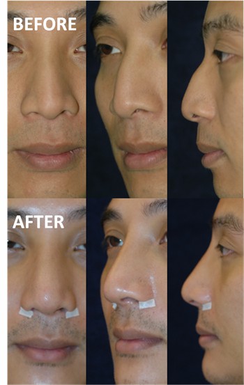 Rhinoplasty Clinic Thailand  and dermatology center