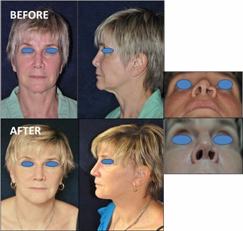 Rhinoplasty Clinic Thailand  and dermatology center