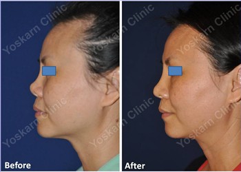 Rhinoplasty Clinic Thailand  and dermatology center