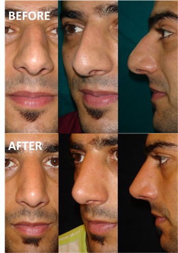 Rhinoplasty Clinic Thailand  and dermatology center