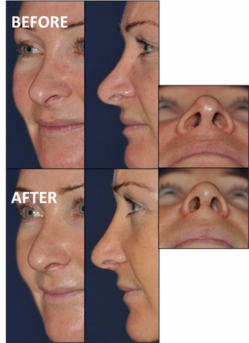 Rhinoplasty Clinic Thailand  and dermatology center