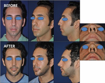 Rhinoplasty Clinic Thailand  and dermatology center