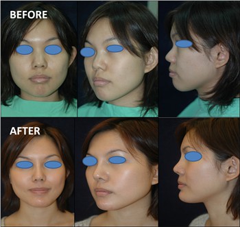 Rhinoplasty Clinic Thailand  and dermatology center