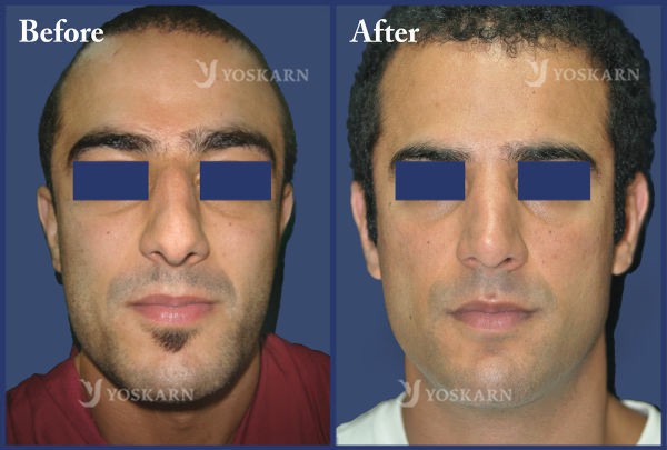 Rhinoplasty Clinic Thailand  and dermatology center