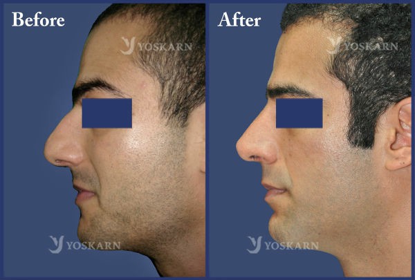 Rhinoplasty Clinic Thailand  and dermatology center