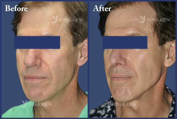 Rhinoplasty Clinic Thailand  and dermatology center