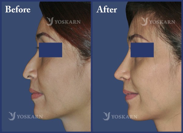 Rhinoplasty Clinic Thailand  and dermatology center