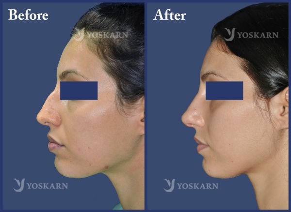 Rhinoplasty Clinic Thailand  and dermatology center