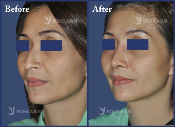 Rhinoplasty Clinic Thailand  and dermatology center