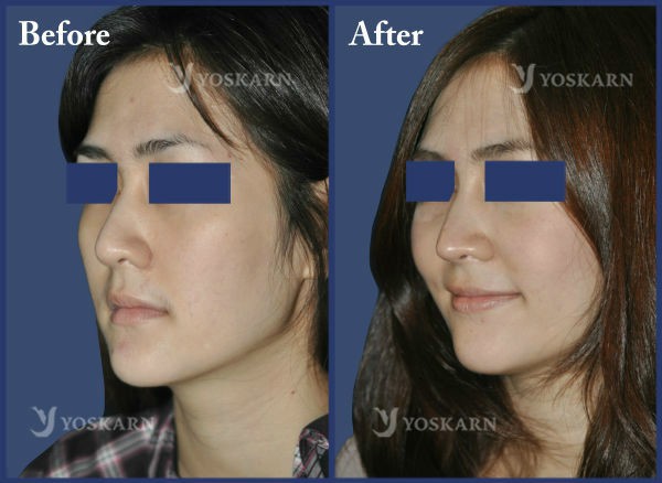 Rhinoplasty Clinic Thailand  and dermatology center