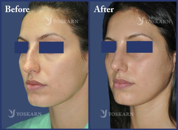 Rhinoplasty Clinic Thailand  and dermatology center