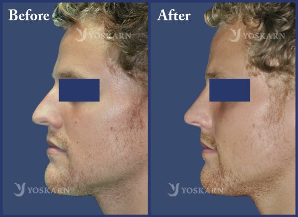 Rhinoplasty Clinic Thailand  and dermatology center