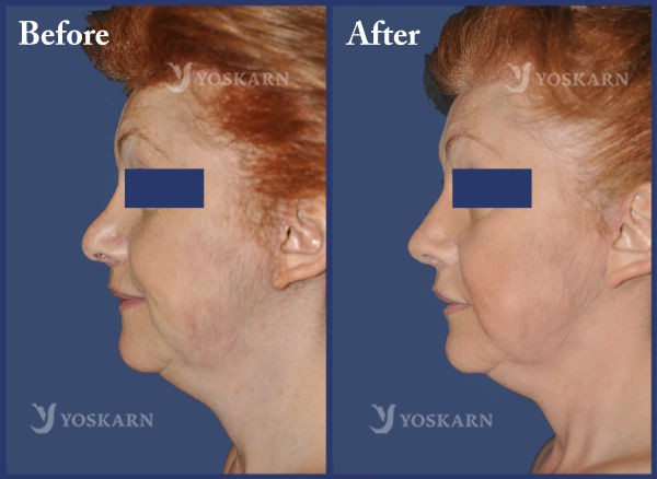 Rhinoplasty Clinic Thailand  and dermatology center