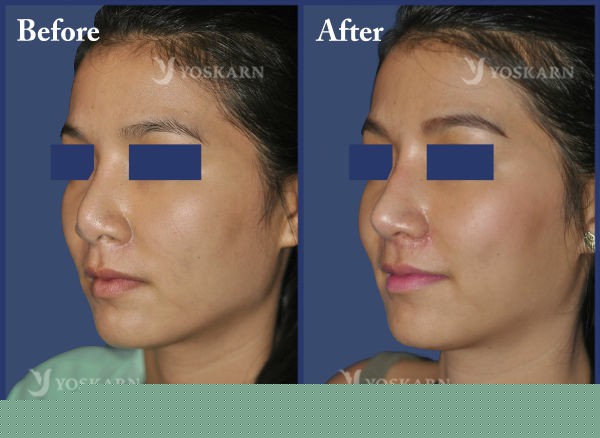 Rhinoplasty Clinic Thailand  and dermatology center