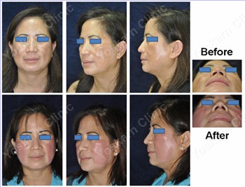 Rhinoplasty Thailand and dermatology center