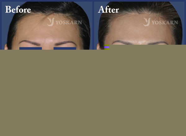 Rhinoplasty Clinic Thailand  and dermatology center
