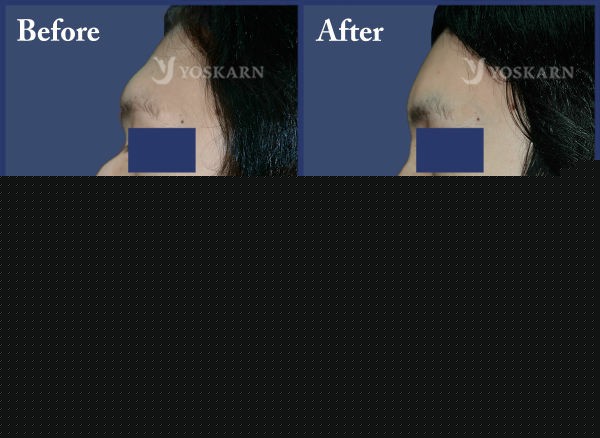 Rhinoplasty Clinic Thailand  and dermatology center