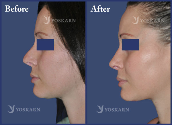 Rhinoplasty Clinic Thailand  and dermatology center