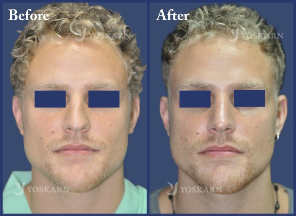 Rhinoplasty Clinic Thailand  and dermatology center