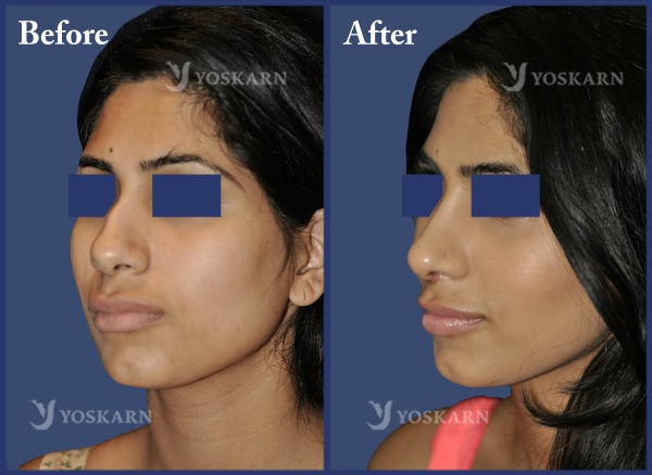 Rhinoplasty Clinic Thailand  and dermatology center