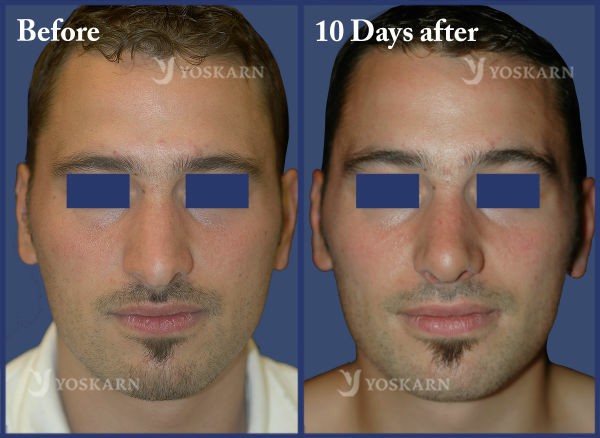 Rhinoplasty Clinic Thailand  and dermatology center