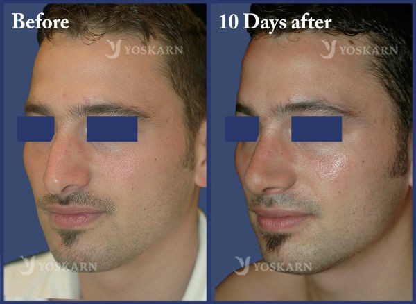 Rhinoplasty Clinic Thailand  and dermatology center