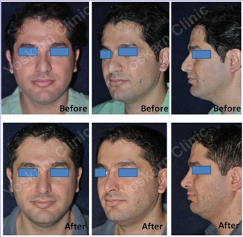 Rhinoplasty Thailand and dermatology center