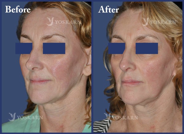 Rhinoplasty Clinic Thailand  and dermatology center