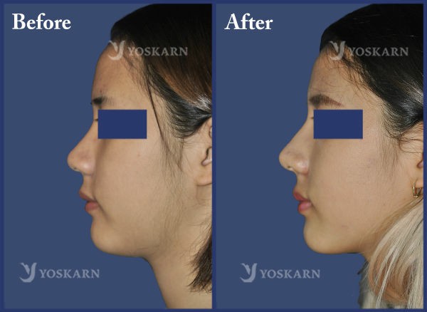 Rhinoplasty Clinic Thailand  and dermatology center