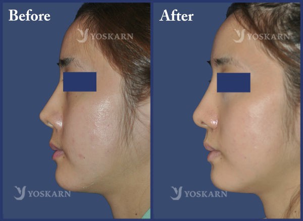 Rhinoplasty Clinic Thailand  and dermatology center