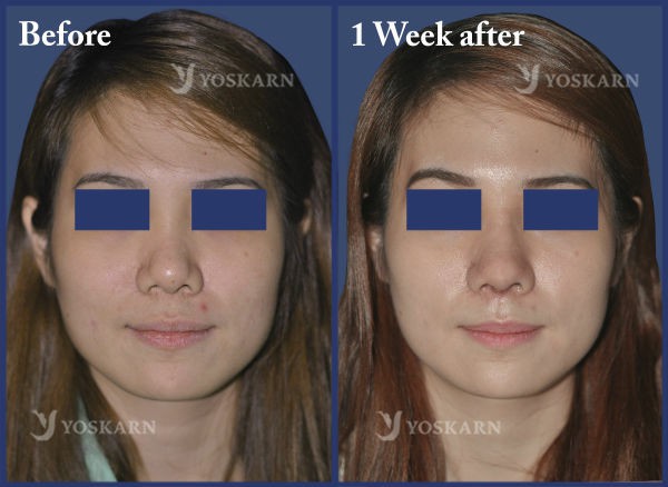 Rhinoplasty Clinic Thailand  and dermatology center