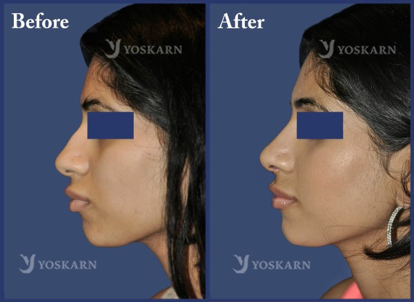 Rhinoplasty Clinic Thailand  and dermatology center