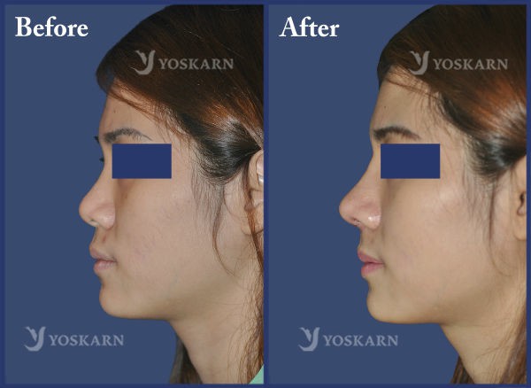 Rhinoplasty Clinic Thailand  and dermatology center