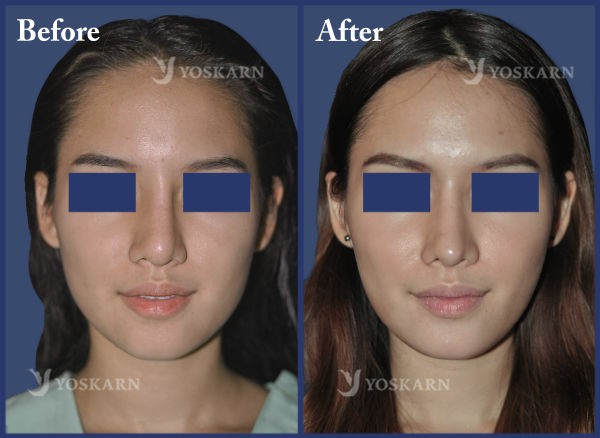 Rhinoplasty Clinic Thailand  and dermatology center