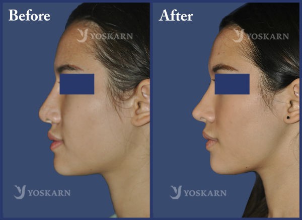 Rhinoplasty Clinic Thailand  and dermatology center