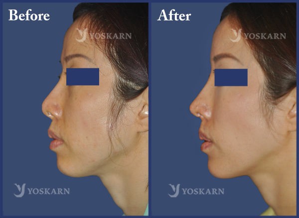 Rhinoplasty Clinic Thailand  and dermatology center