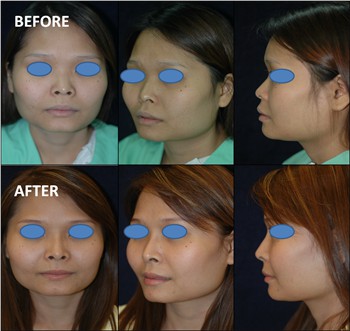 Rhinoplasty Thailand and dermatology center