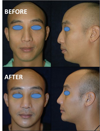 Rhinoplasty Thailand and dermatology center
