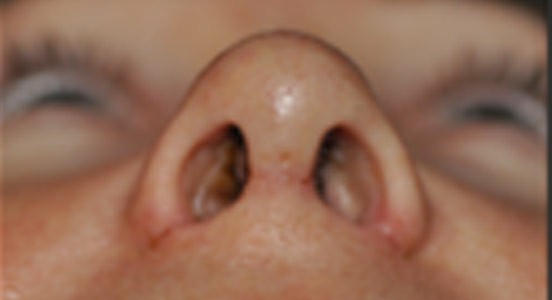 Rhinoplasty Thailand and dermatology center