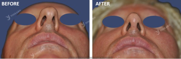 Rhinoplasty Thailand and dermatology center