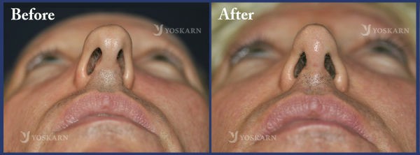 Rhinoplasty Thailand and dermatology center