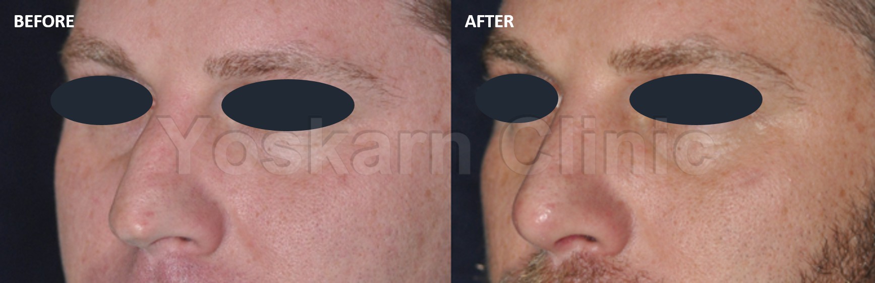 Rhinoplasty Thailand and dermatology center