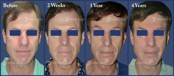 Rhinoplasty Thailand and dermatology center