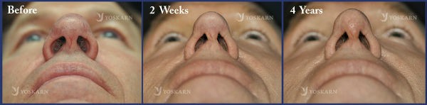 Rhinoplasty Thailand and dermatology center