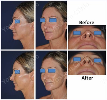 Rhinoplasty Thailand and dermatology center