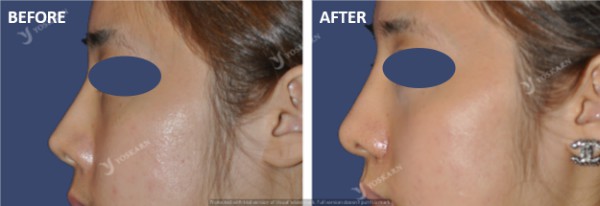 Rhinoplasty Clinic Thailand  and dermatology center
