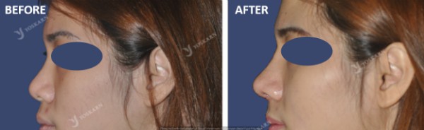 Rhinoplasty Clinic Thailand  and dermatology center