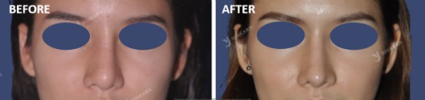 Rhinoplasty Clinic Thailand  and dermatology center