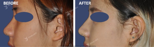Rhinoplasty Clinic Thailand  and dermatology center